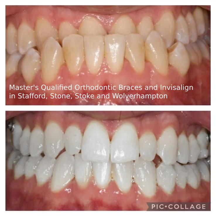 Masters-Qualified-Orthodontic-Braces.jpg